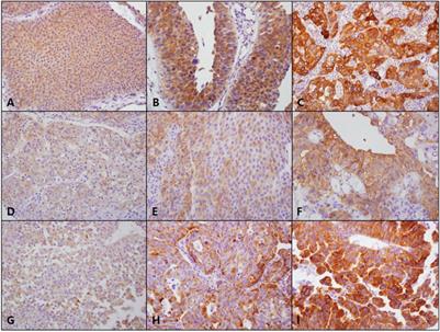 Upregulation of Fatty Acid Transporters is Associated With Tumor Progression in Non-Muscle-Invasive Bladder Cancer